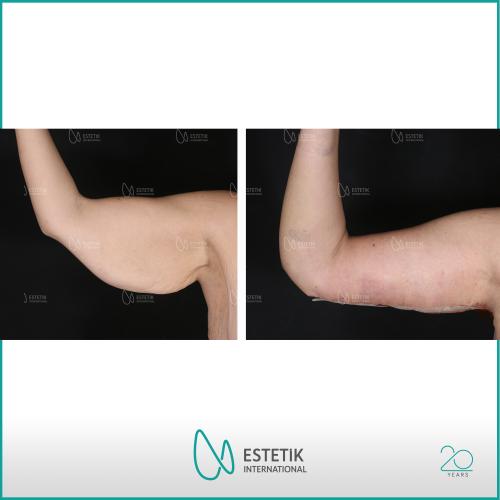 صور قبل وبعد لمرضانا - الجراحة التجميلية - د. مرفة أوفلاز